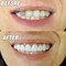Instant Smile Comfort Fit Flex - Bright White - Upper Veneer Cosmetic Teeth
